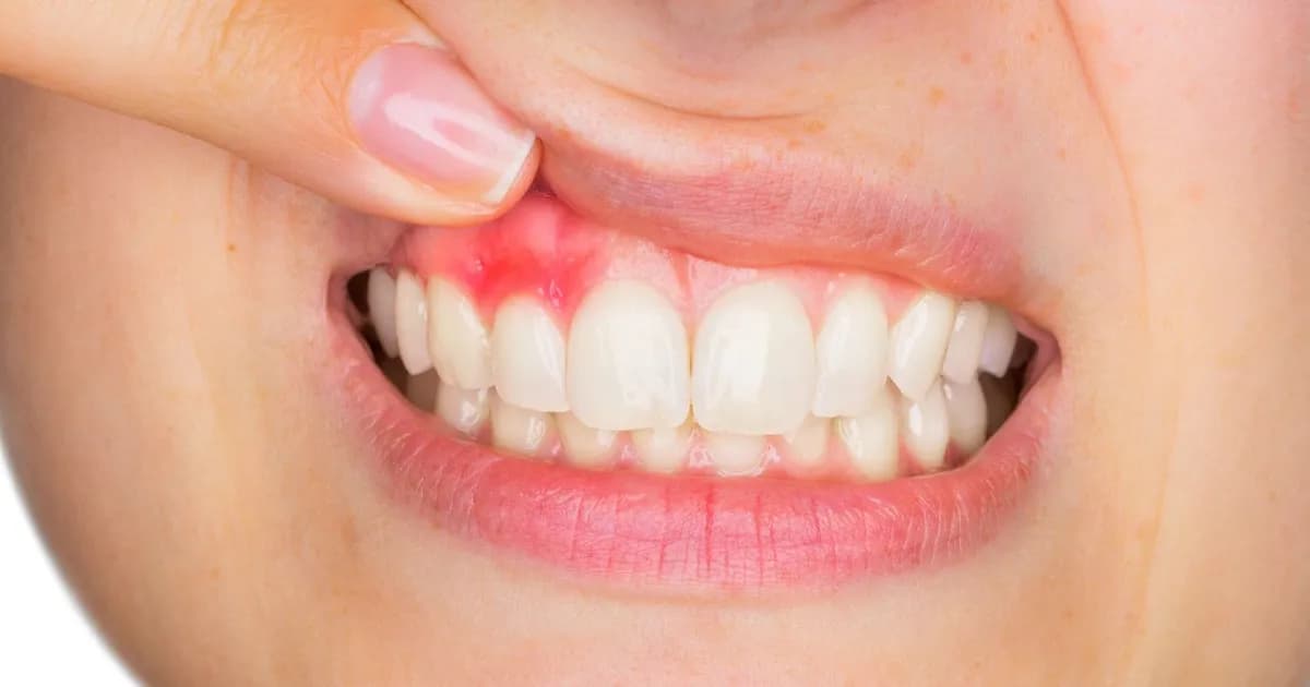 Skuteczne metody leczenia krost w jamie ustnej i ich przyczyny