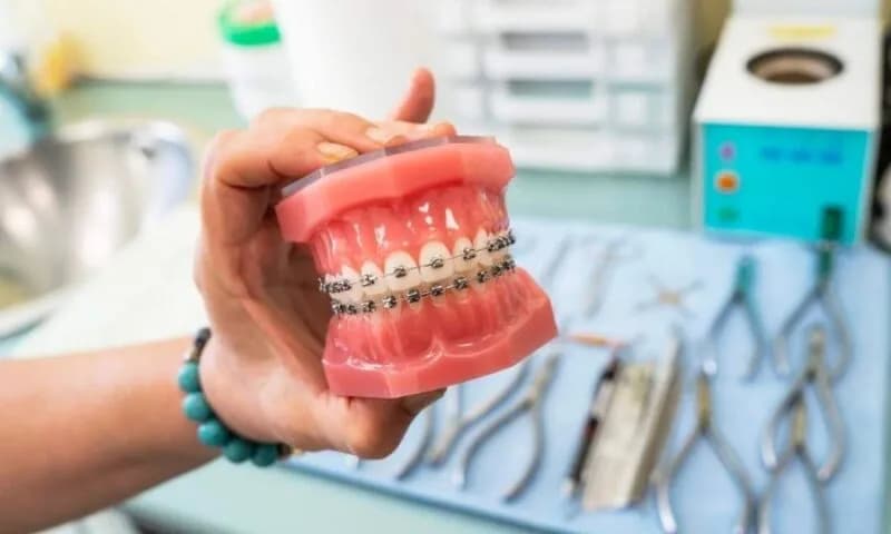 Ile kosztuje aparat na zęby? Ceny i ukryte wydatki, które musisz znać