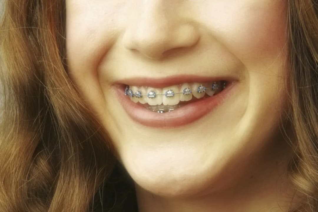 Czy aparat na zęby powiększa usta? Odkryj subtelne zmiany w wyglądzie