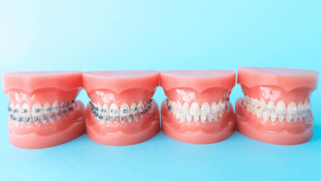 Ile kosztuje aparat na zęby na noc? Ceny i ważne informacje