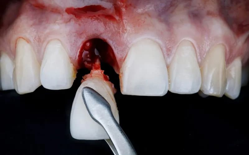 Jak goi się dziąsło po wyrwaniu zęba - uniknij bólu i powikłań