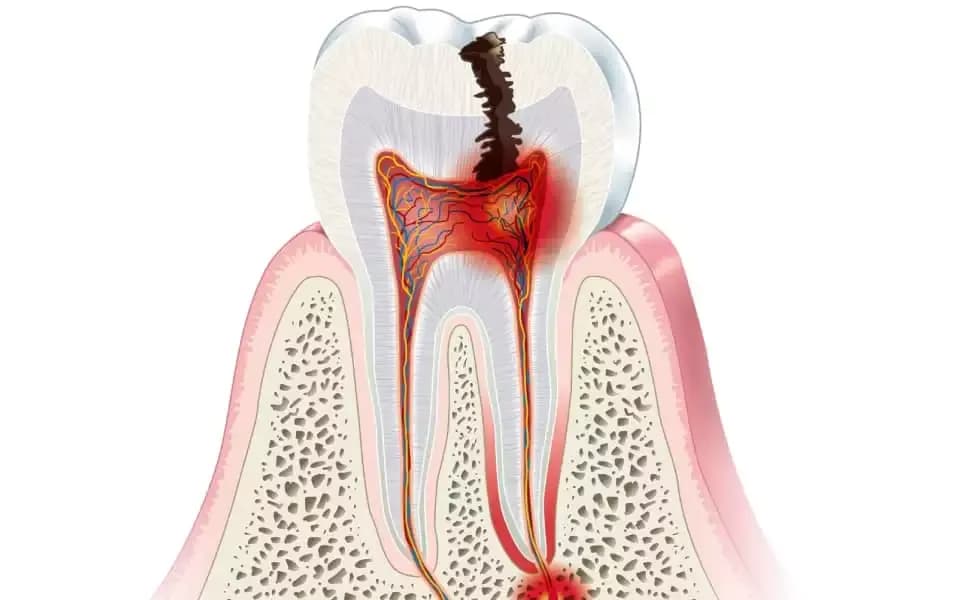 Czy dentysta wyrwie zęba z ropą? Poznaj ryzyko i rozwiązania