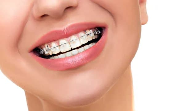Czy zakładanie aparatu na zęby boli? Prawda o bólu i dyskomforcie