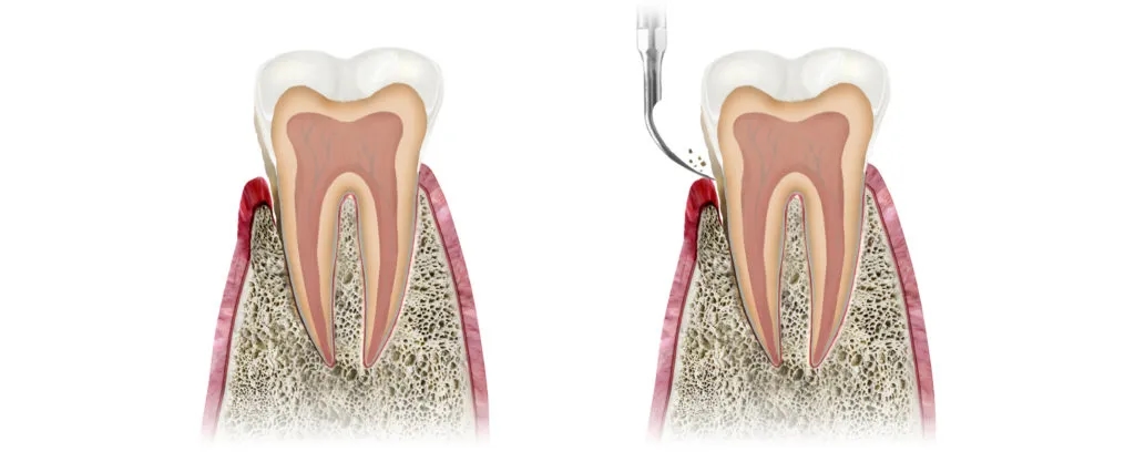 Jak skutecznie wyciągnąć ropę z dziąsła i uniknąć bólu