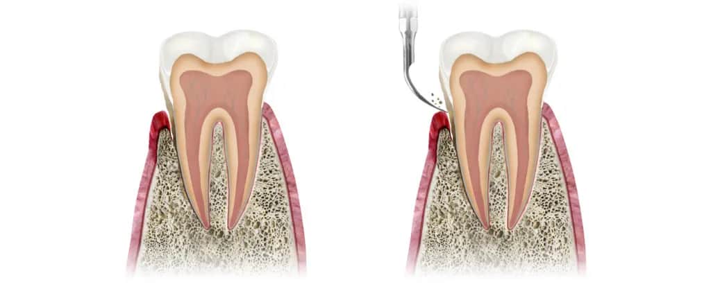 Jak skutecznie wyciągnąć ropę z dziąsła i uniknąć bólu