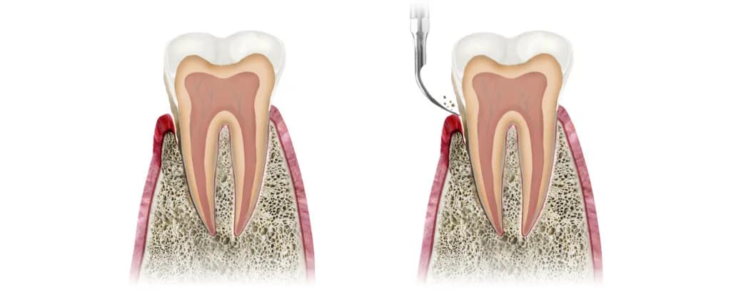 Jak skutecznie usunąć ropę na dziąśle i uniknąć poważnych problemów