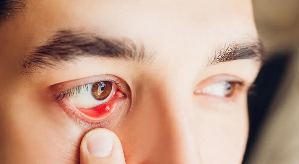 Jakie leki na jęczmień na oku? Skuteczne metody leczenia i ulgi