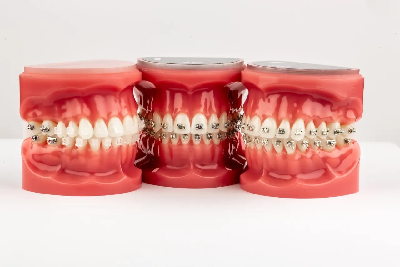 Jak wygląda stały aparat na zęby? Odkryj jego różne typy i wygląd