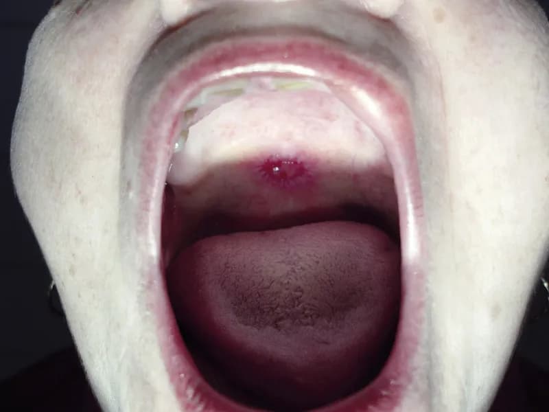 Objawy kiły w jamie ustnej: jak je rozpoznać i uniknąć powikłań