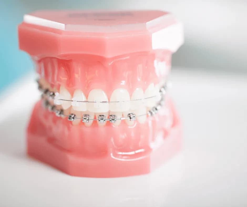 Jak wyglądają aparaty na zęby? Różnice, estetyka i komfort noszenia