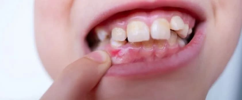 Jak skutecznie leczyć zapalenie jamy ustnej u dziecka i złagodzić ból