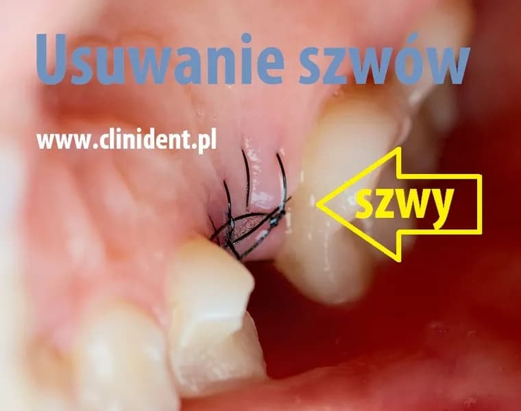 Ile kosztuje zdjęcie szwów u dentysty? Ceny, które zaskoczą!