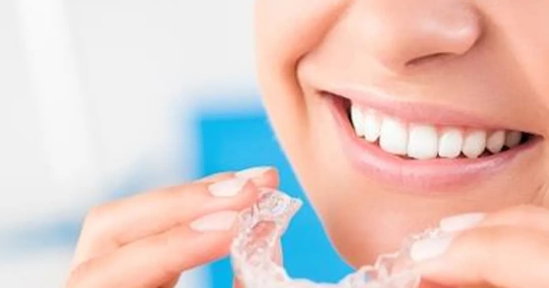 Ile kosztuje nakładka na zęby po aparacie? Sprawdź ceny i opcje