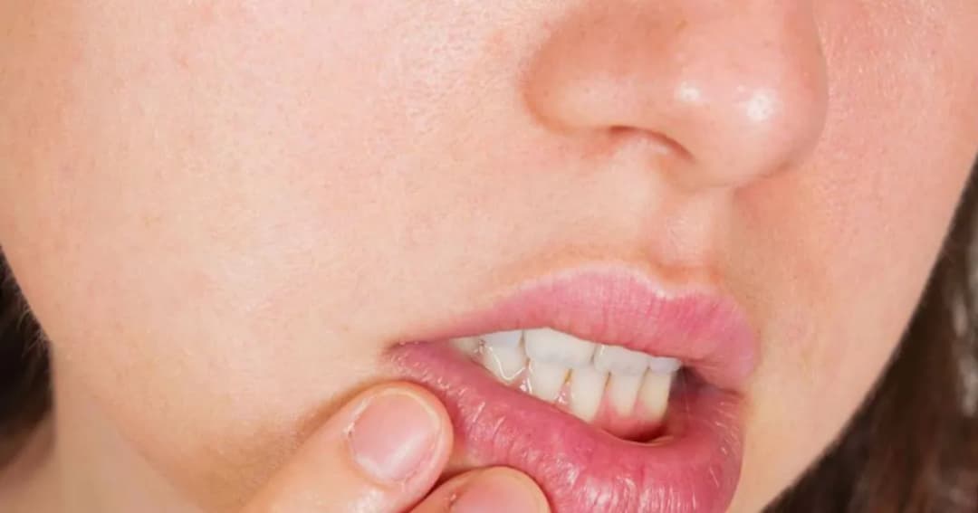 Co to jest afta w jamie ustnej i jak uniknąć bólu i dyskomfortu