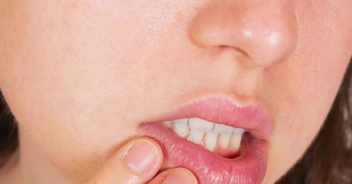 Co to jest afta w jamie ustnej i jak uniknąć bólu i dyskomfortu
