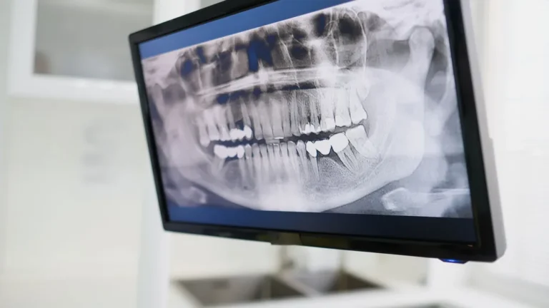 Close-up of a dental X-ray displayed on a monitor in a dental clinic setting, emphasizing dental care technology.