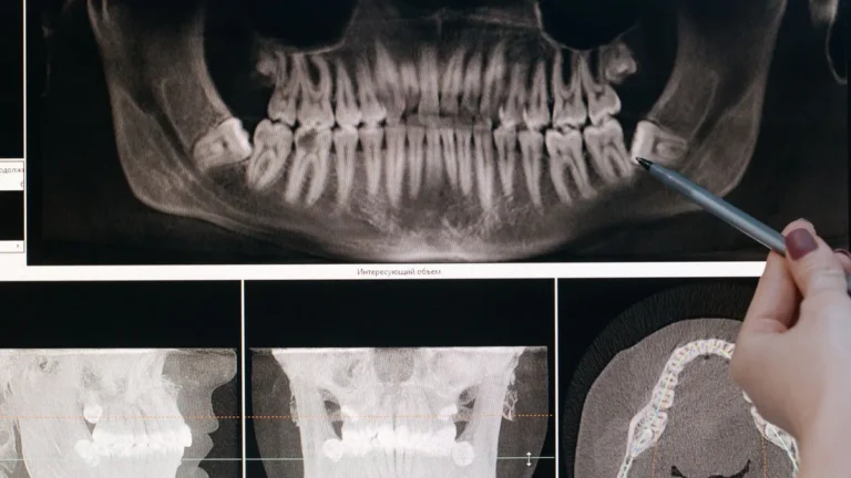 Detailed dental X-ray showing teeth structure highlighted by a pointing pen.