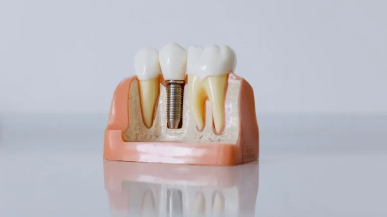 Detailed dental implant model showcasing teeth structure for educational purposes.