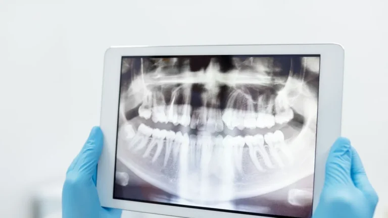 Blue-gloved hands holding a digital tablet displaying a detailed dental X-ray scan.