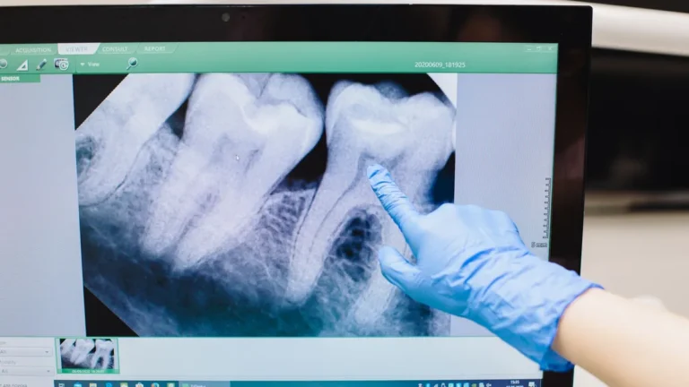 Close-up of a dental X-ray displayed on a monitor with a gloved hand pointing.