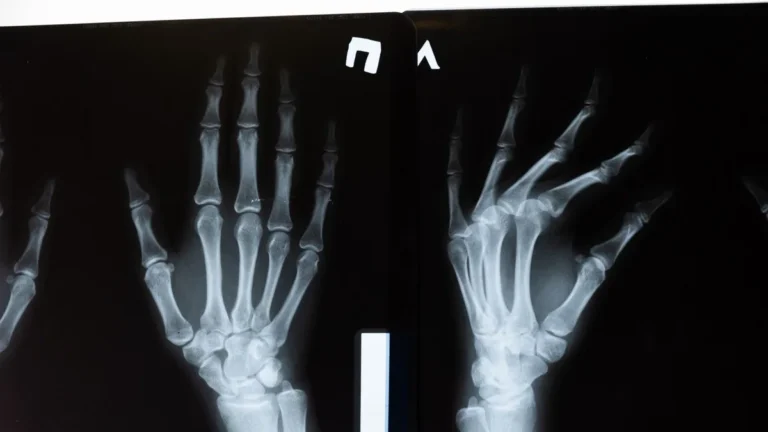 High-resolution x-ray image showing the intricate anatomy of human hands.